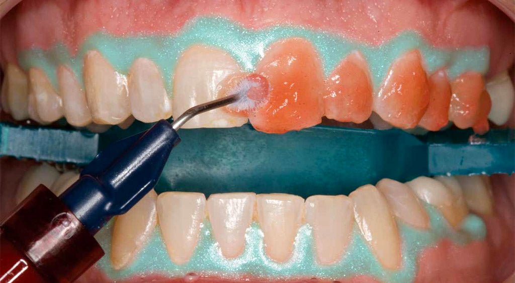 Blanqueamientos - Alpha Dental Soluciones